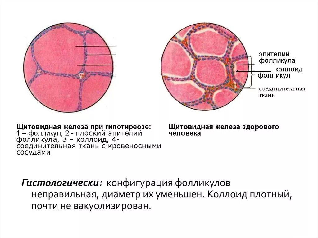 Гиперфункция щитовидной железы эпителий фолликулов. Гистологическое строение щитовидной железы. Гипотиреоз препарат гистология. Щитовидная железа гистология препарат.