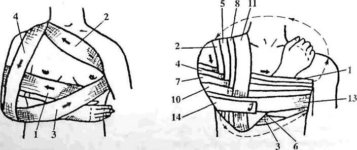Повязка на молочные железы алгоритм. Перевязка Вельпо алгоритм. Схема наложения повязки Вельпо. Повязка Вельпо бинтом. Десмургия Вельпо.