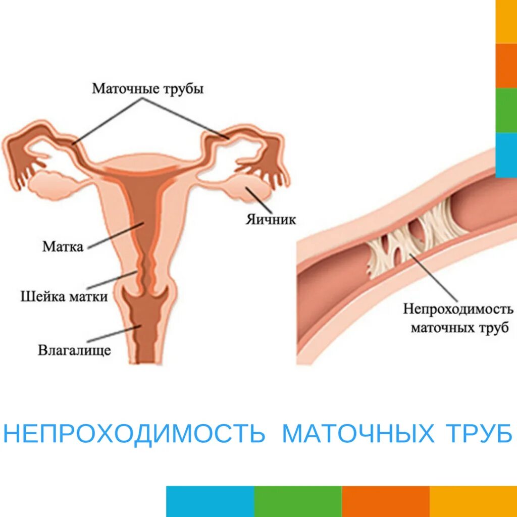 Можно забеременеть при непроходимости труб. Психологическая непроходимость маточных труб. Маточные трубы. Непроходимые маточные трубы. Непроходимость фаллопиевых труб.