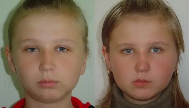асимметрия лица у подростка