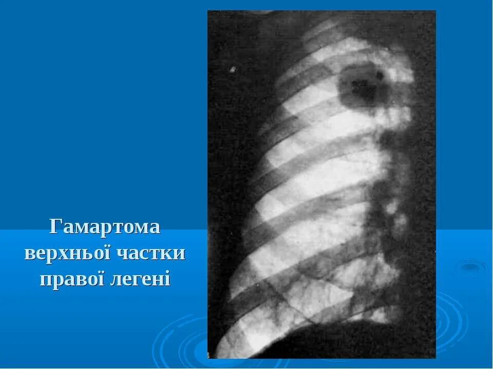 Опухоль верхней доли легкого. Периферическое образование в легких что это. Опухоль верхней доли легкого. Туберкулез бронхов рентгенограмма. Объемное образование бронха на кт.