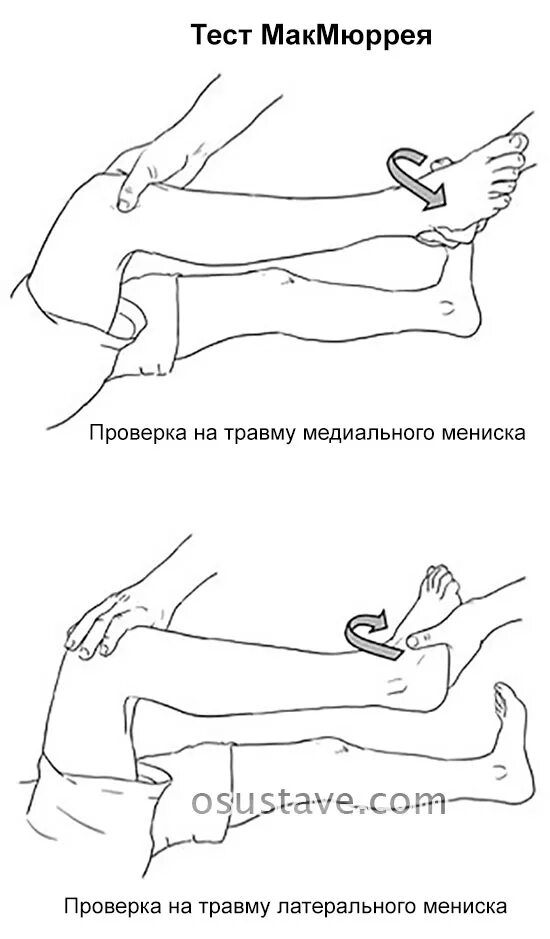 Симптом блокады при повреждении менисков. Тесты при повреждении мениска. Симптом Байкова в коленном суставе. Симптомы разрыва мениска Байкова. Симптом байкова