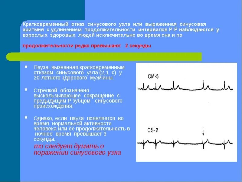 Синусовая аритмия экг проявления. Недыхательная синусовая аритмия на экг. Синусовая пауза на экг. Синусовая аритмия паузы. Экг при синусовой аритмии.