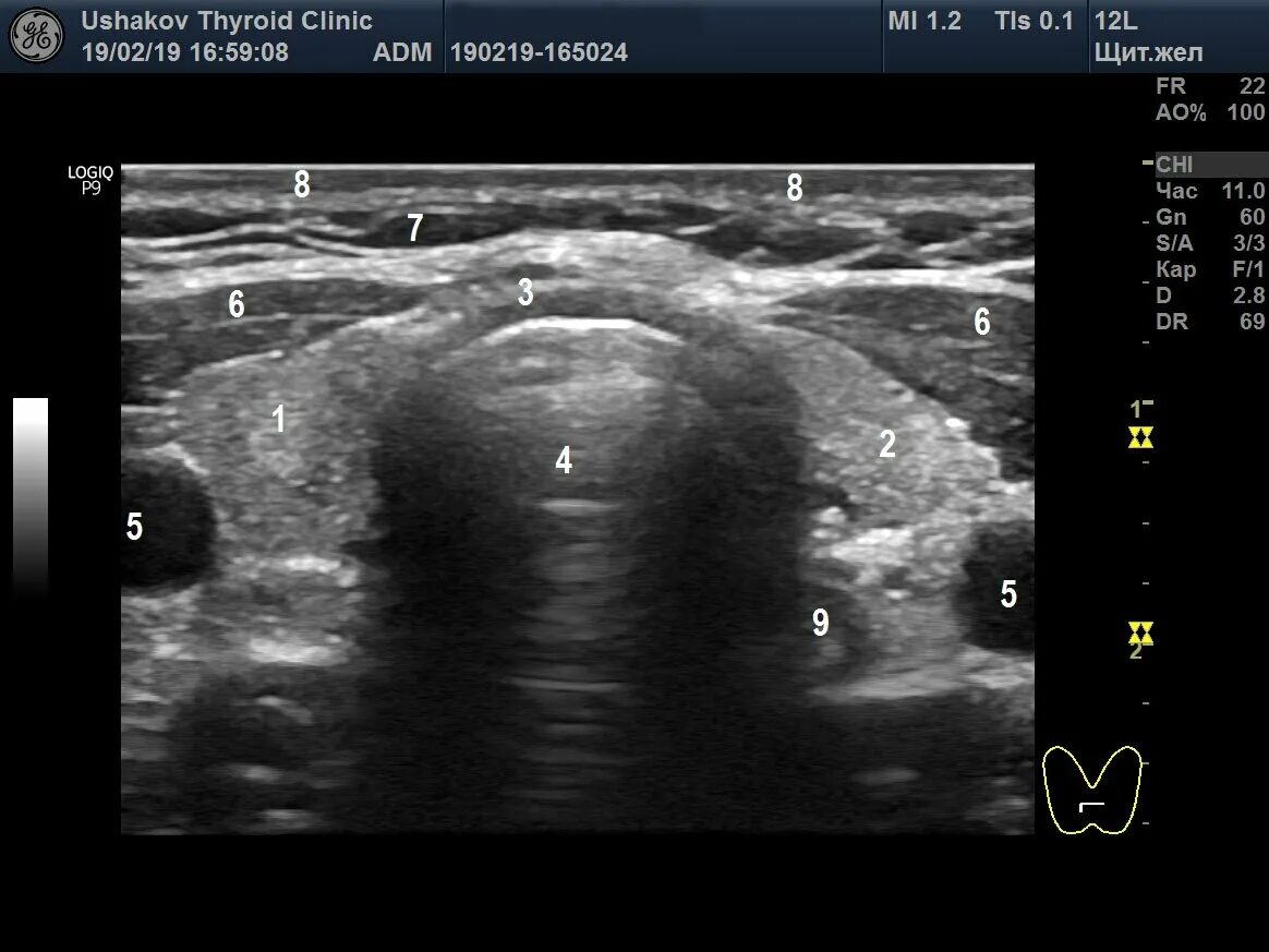 Сонограмма щитовидной железы. Аплазия щитовидной железы на УЗИ. Гипоплазия щитовидной железы железы. Гипоплазия доли щитовидной. Можно ли перед узи щитовидной железы есть
