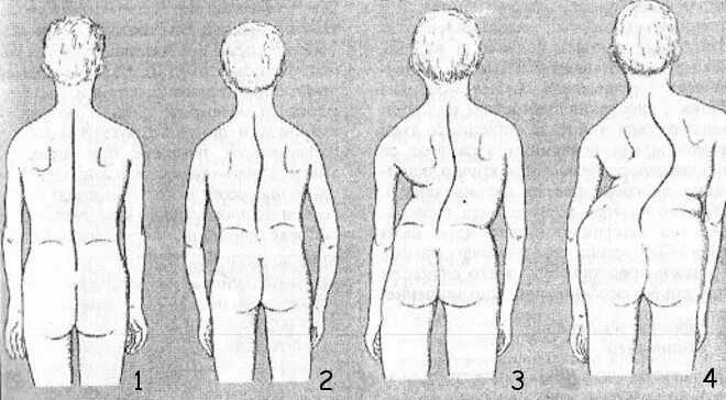 Искривление позвоночника 1 степени. Симптомы сколиоз 1 степени у детей. Нормальный позвоночник и сколиоз. Что такое сколиоз 1 степени. Сколиоз позвоночника 4 степени рентген.