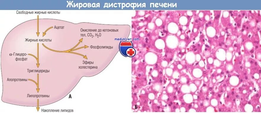 Печень в организме в жире. Жировая инфильтрация печени. Механизм развития печеночной дистрофии. Жировая печень (дегенерация печени). Жировой гепатоз печени гистология.