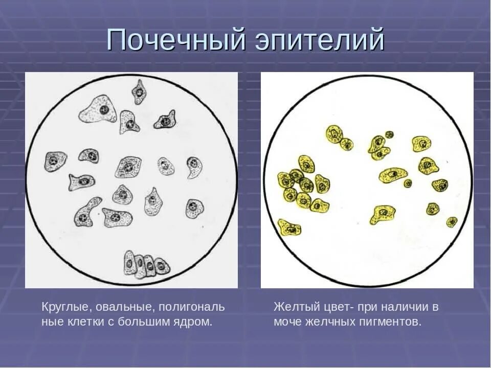 Повышенный эпителий в моче у мужчин. Плоский и почечный эпителий. Микроскопия мочи клетки почечного эпителия. Почечный эпителий жироперерожденный. Микроскопия мочи эпителий плоский.