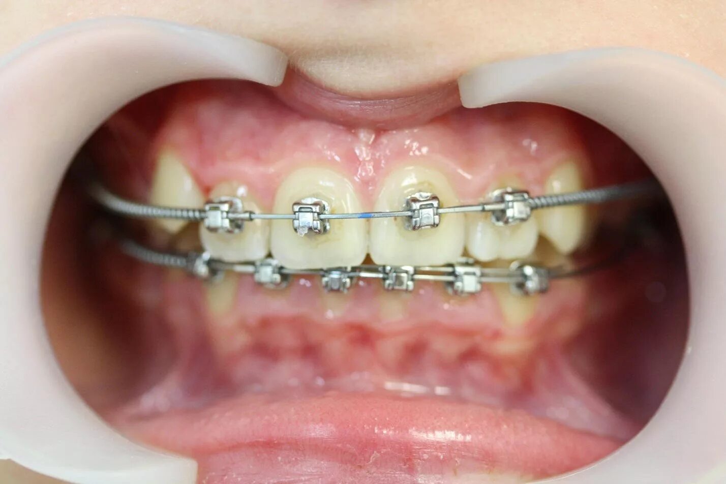Частичная брекет-система 2x4. Частичная брекет система 2 на 4. Система ортодонтическая 2*4. Брекеты на зубы для детей сколько стоят