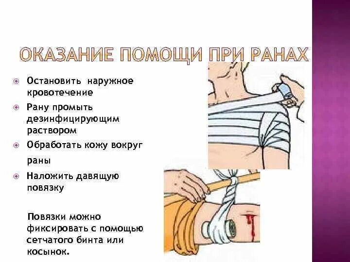При кровотечении накладывают повязку. Наложение повязок на раны. наложить давящую повязку на кровоточащую рану. повязки при кровотечениях. обработка раны и наложение повязки.