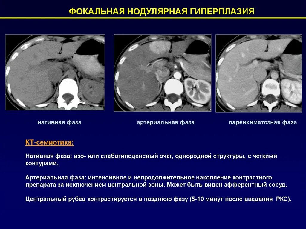 Нодулярная гиперплазия печени на кт. Фокальная Узловая гиперплазия печени кт. Фокальная нодулярная гиперплазия печени на кт. Очаговая Узловая гиперплазия печени кт.