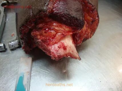 The woman’s body was dismembered in the autopsy room 