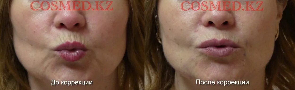 Middle age (BEFORE PIC) Lip wrinkles, How to line lips, Wrinkle treatment