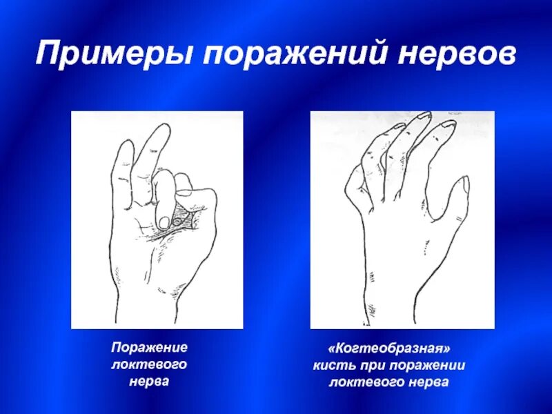 Повреждение локтевого нерва. Симптомы поражения локтевого нерва неврология. Поражение лок евого нерва. Нейропатия срединного нерва. Поражение срединного и локтевого нерва.