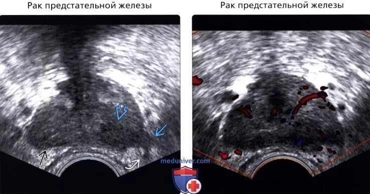 Узел в простате. Аденоматозный узел предстательной железы. УЗИ простаты Диагностер. УЗИ предстательной железы трансректальным датчиком. Аденома предстательной железы на УЗИ.