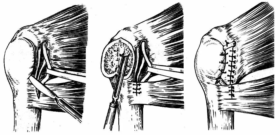 Операция Бойчева при привычном вывихе плеча. Операция Краснова при привычный вывих плеча. Привычный вывих плеча Бойчев 2.