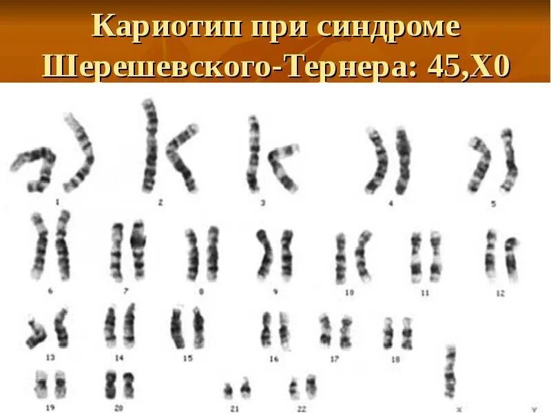Синдром шерешевского тернера хромосомы кариотип. Синдром шерешевского тернера кариотип. синдром вольфа-хиршхорна кариотип. синдром марфана кариотип.