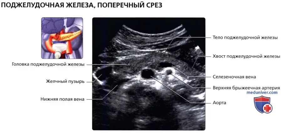 Ультразвуковое исследование поджелудочной железы норма. Нормальная поджелудочная железа на УЗИ. Проток поджелудочной железы в норме УЗИ. Размеры поджелудочной железы на УЗИ норма.