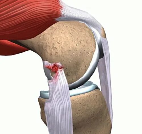 Лигаментоз связок коленного сустава. Повреждение внутренней коллатеральной связки. Коллатеральная связка колена повреждение. Частичный разрыв коллатеральной связки.