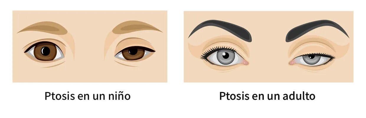 Ptosis латынь. Врожденный птоз рисунок. ptosis icon.