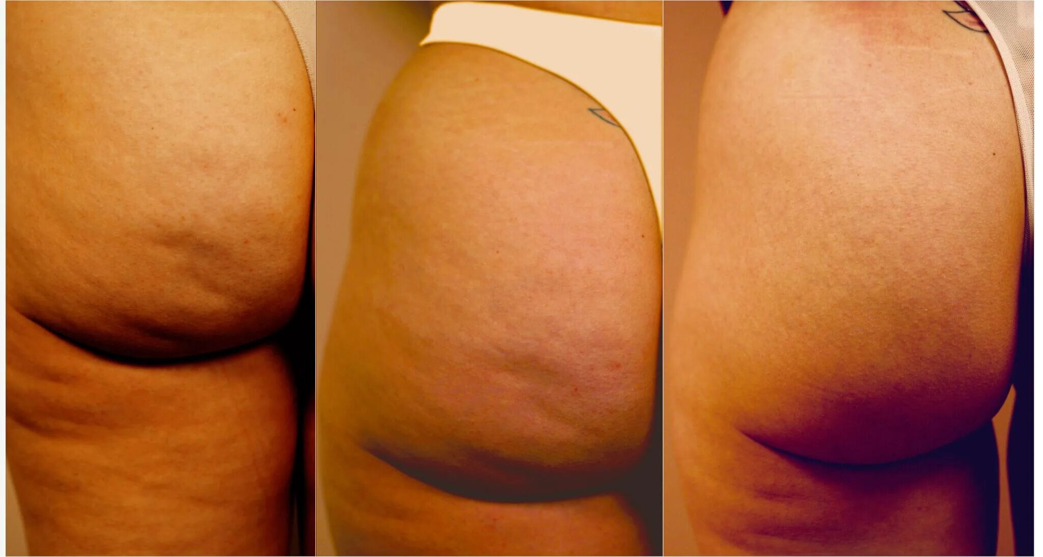 Как убрать целлюлит у женщин. Целлюлит до и после. Липодистрофия целлюлит. Как убрать целлюлит у женщин. Обертывания от целлюлита на ляшках.