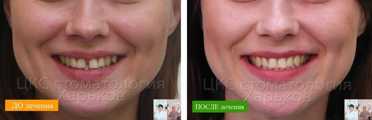Как убрать щель. Виниры закрытие диастемы. виниры на щель между передними зубами.