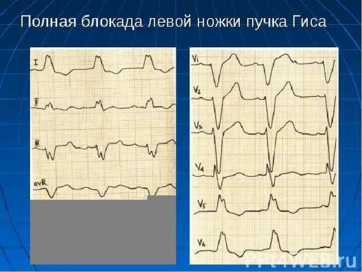 Разветвление верхней левой ножки пучка гиса. Полная блокада левой ножки пучка. Полная блокада. Блокада ножек пучка Гиса. Блокада левой ножки пучка Гиса.