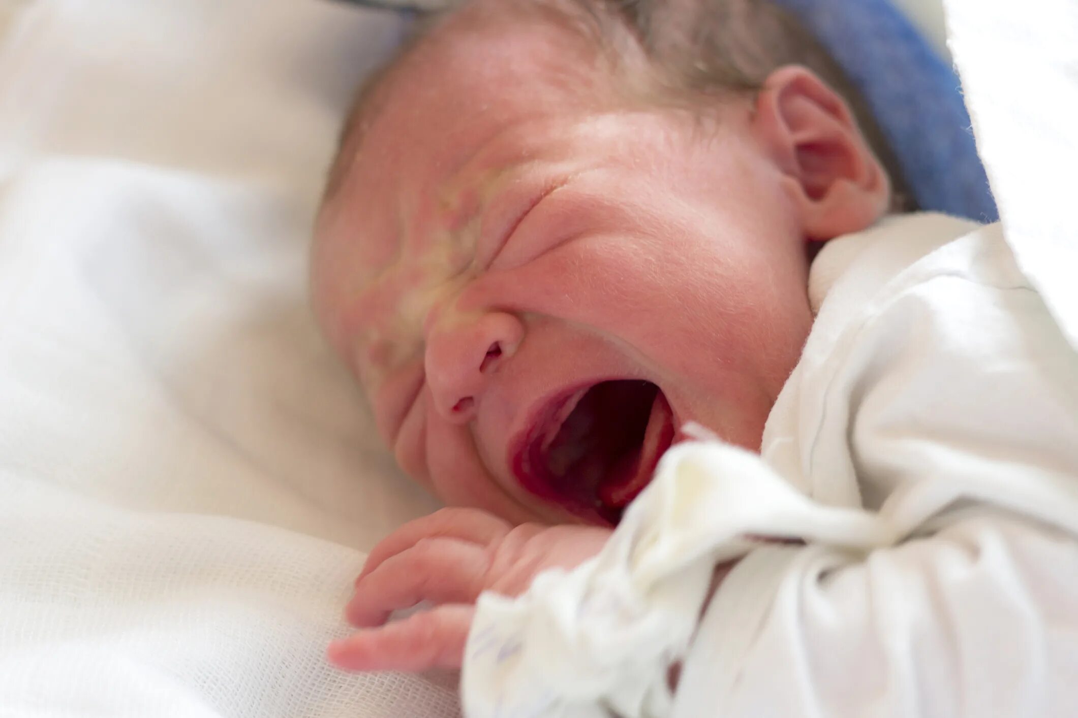 Почему новорожденный высовывает. Сифилитический ринит у новорожденных. Врожденный сифилис у новорожденных. Новорожденный ребенок с сифилисом. Менингит у новорожденного ребенка.