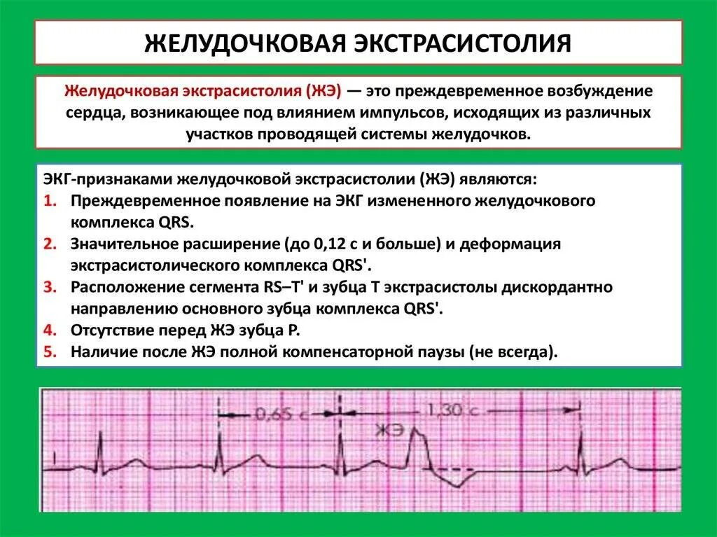 Сколько экстрасистол норма