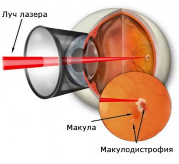 Отслойка сетчатки лазеркоагуляция. Панретинальная лазеркоагуляция сетчатки. Барьерная лазеркоагуляция сетчатки. Отслойка сетчатки лазерная коагуляция.