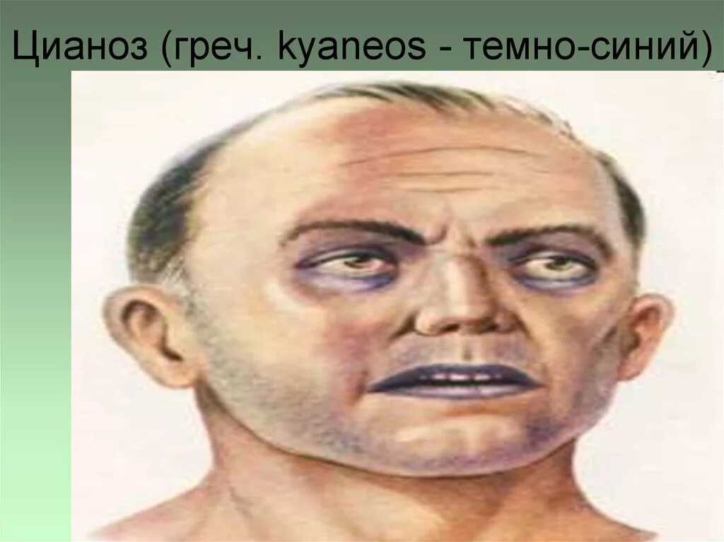 Диффузный Центральный цианоз.