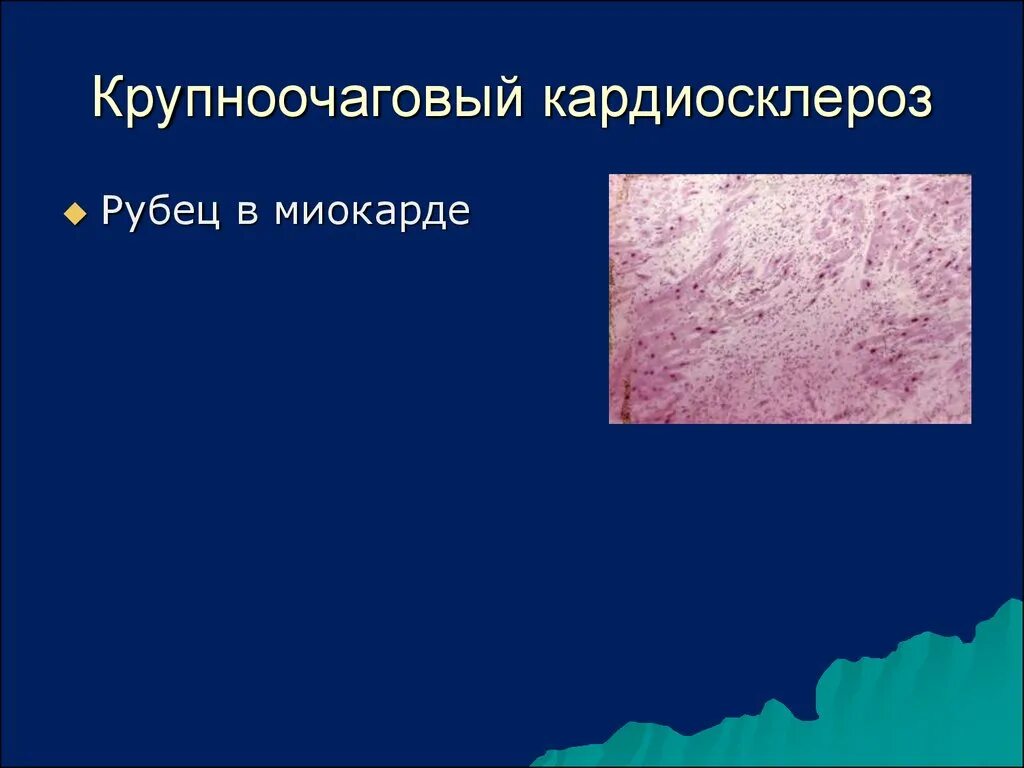 Мелкоочаговый кардиосклероз. Крупноочаговый кардиосклероз. крупноочаговый кардиосклероз микропрепарат. слои грануляционной ткани. постинфарктный крупноочаговый кардиосклероз описание.