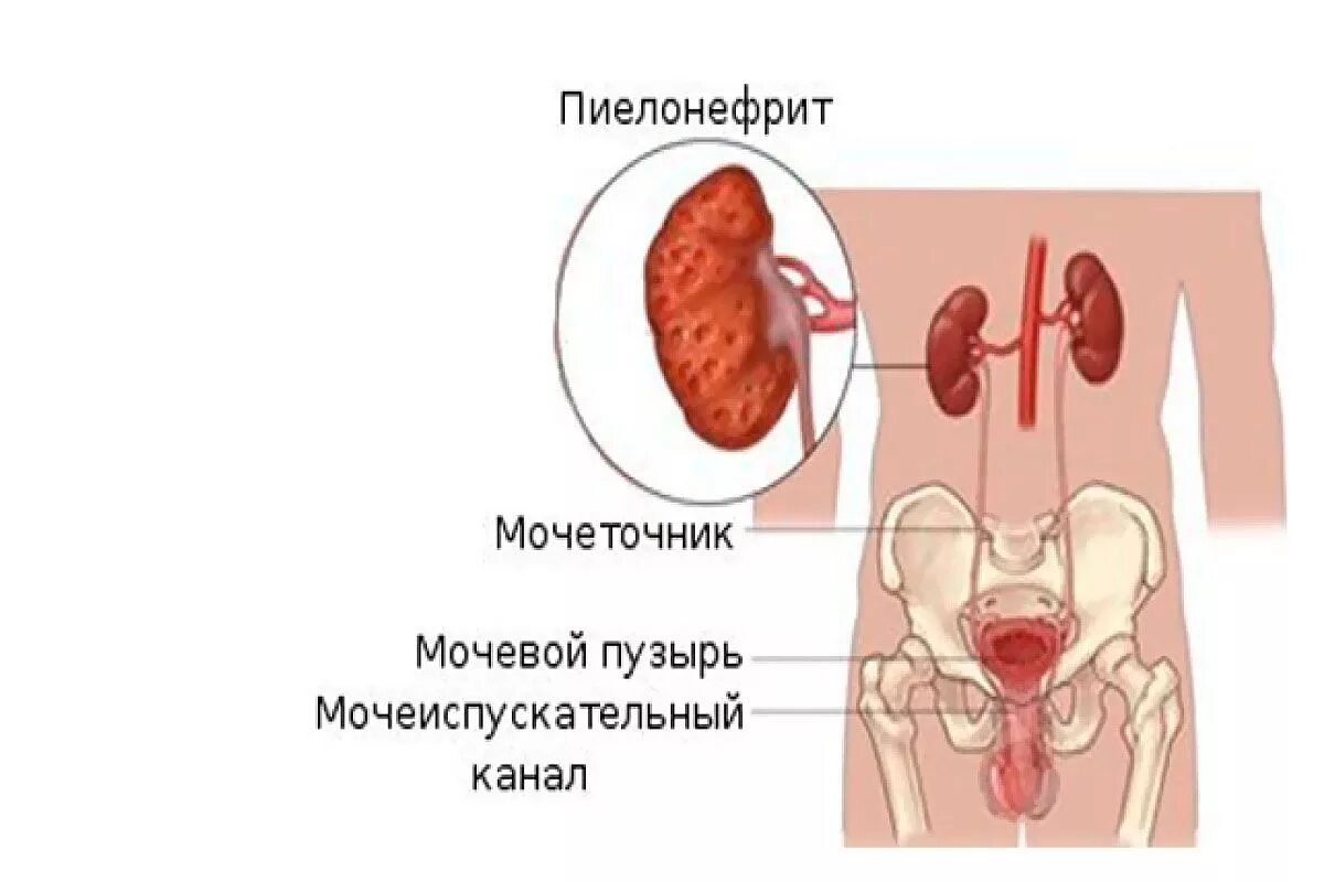 Хронический пиелонефрит почек.