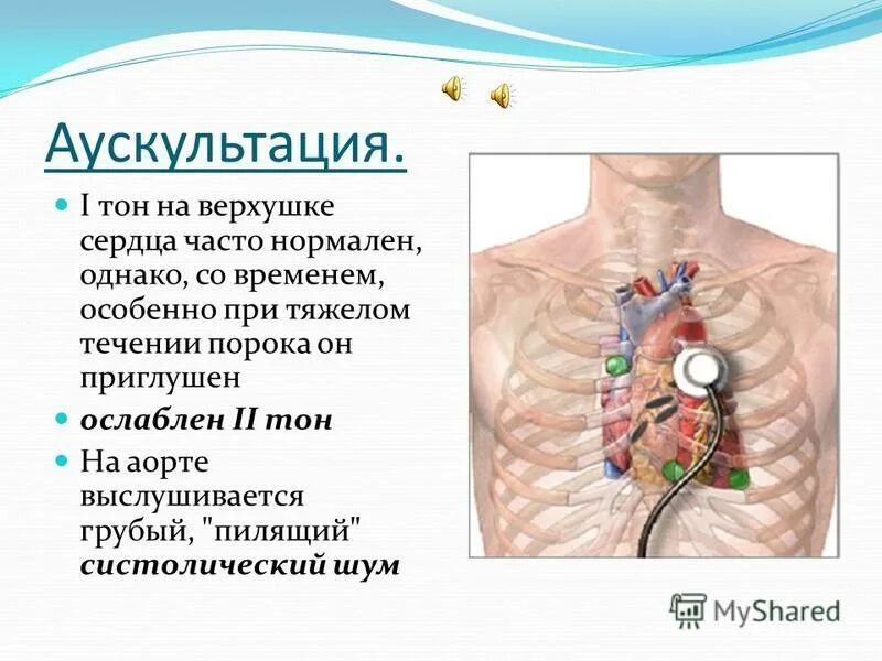 точка выслушивания митрального клапана. ослабление 1 тона на верхушке сердца характерно для. аускультация сердца в норме. акцент второго тона при недостаточности митрального клапана. ослабление ii тона на аорте.