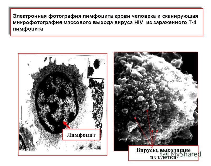 ВИЧ атакует т лимфоциты. Микрофотография вируса ВИЧ. Лимфоцит зараженный ВИЧ. Поражение т лимфоцитов при ВИЧ. Поражаемые структуры спида