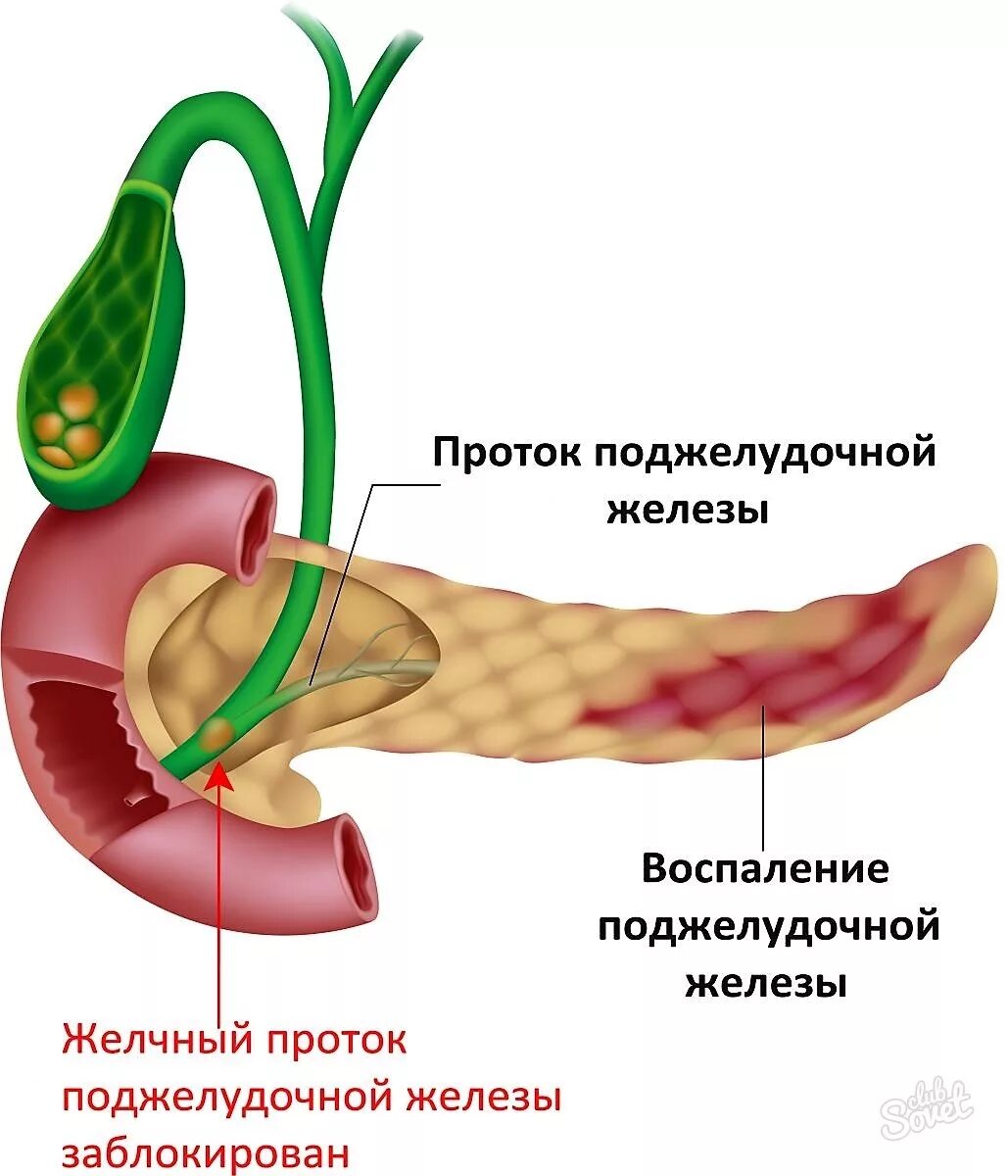 Как болит желчный симптомы у мужчин. Острый панкреатит поджелудочной железы. Хронический билиарный панкреатит. Хронический билиарнозависимый панкреатит. Желчный проток и проток поджелудочной.