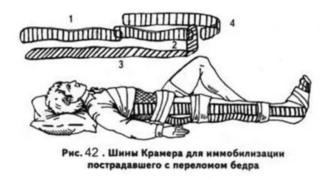 Иммобилизация шиной дитерихса. Шина крамера и дитерихса. Иммобилизация шиной крамера при переломе бедра. Транспортная иммобилизация при переломе бедренной кости. Иммобилизация при переломе шейки бедра лестничная шина.