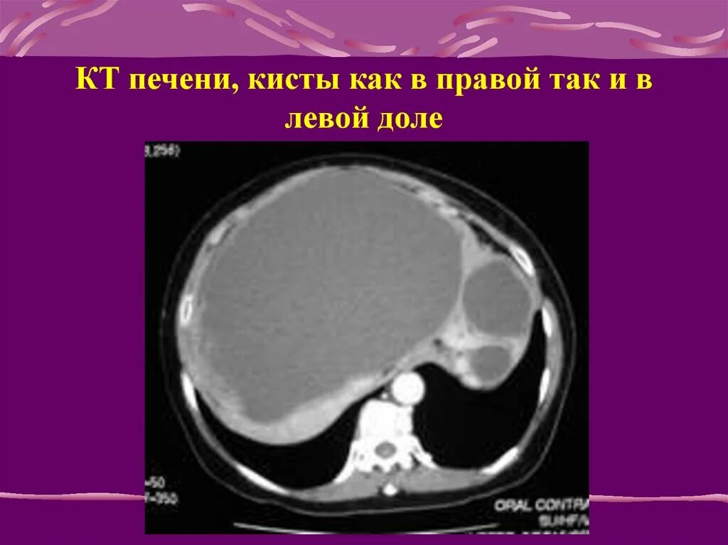Чем лечить кисту левой доли печени. Эхинококковая киста печени кт. Паразитарные кисты печени кт. Кистозные образования печени кт.
