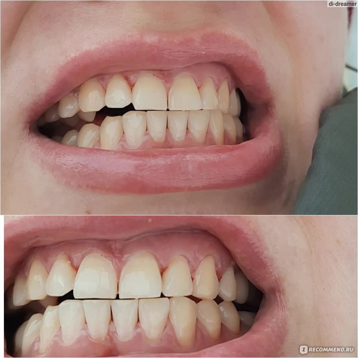 Почему зубы отличаются между собой. Разница до и после чистки зубов.