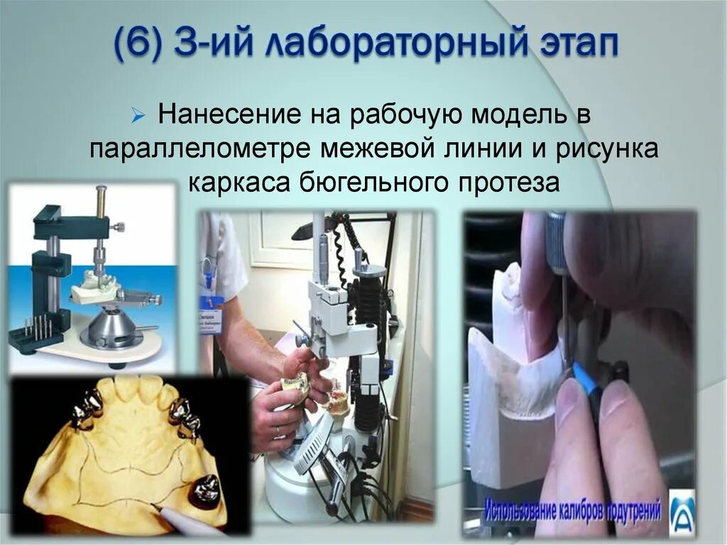 Параллелометрия. Параллелометрия бюгельного протеза. параллелометрия в ортопедической стоматологии. модель в параллелометре. путь введения и выведения бюгельного протеза.