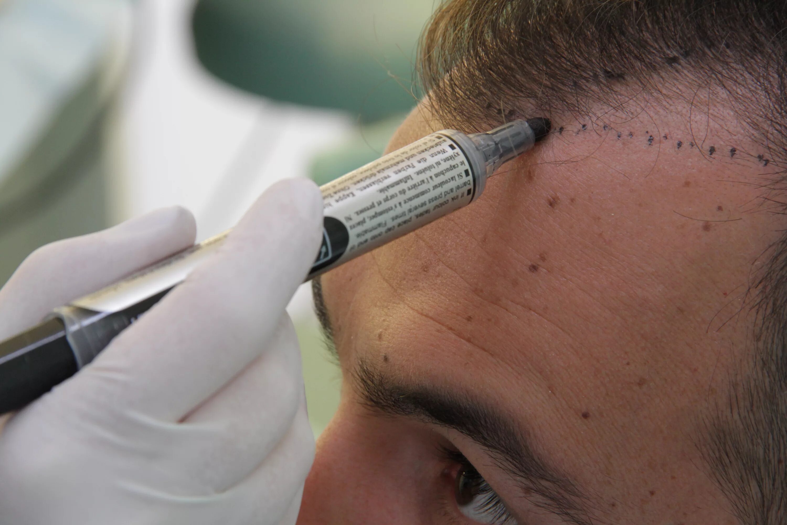 метод пересадки. метод пересадки. методы пересадки волос. метод пересадки ядер. технология dhi.