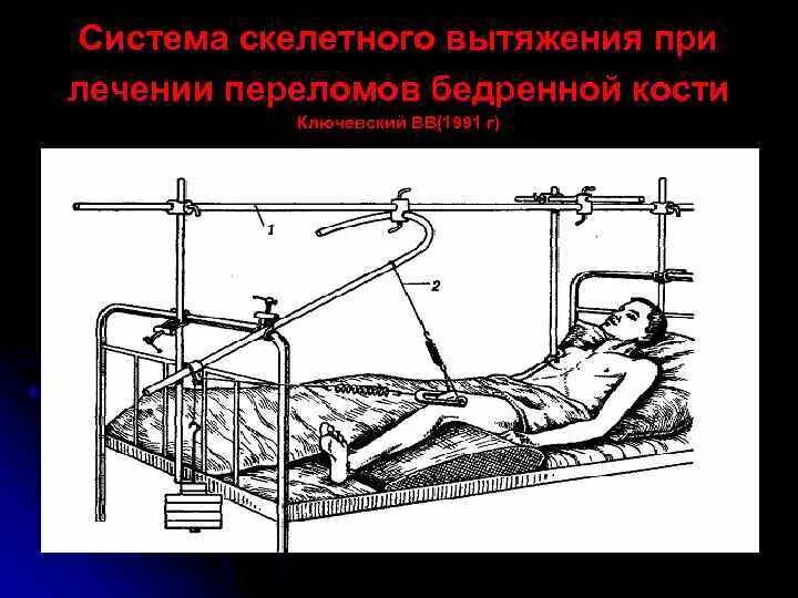 Вытяжение при переломе. Скелетное вытяжение при переломе шейки. скелетное вытяжение по ключевскому. компрессионный перелом позвоночника скелетное вытяжение. вытяжение бедренной кости при переломе.