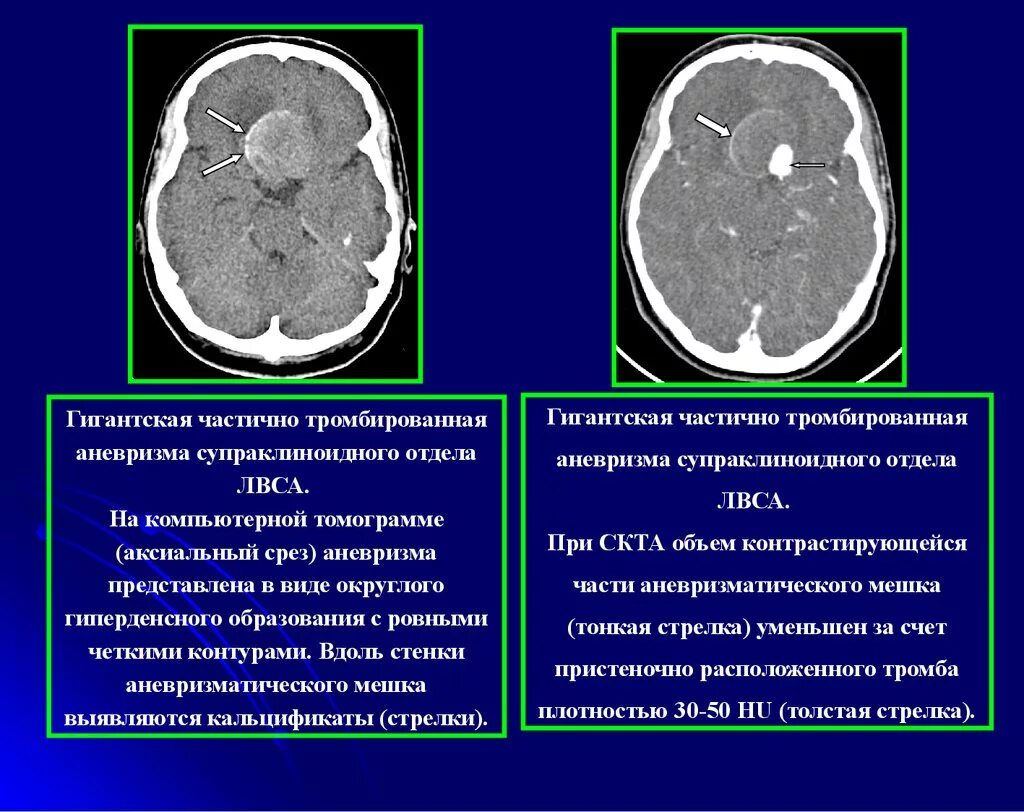 Форум аневризма мозга. Аневризма мозговых артерий кт. Аневризма сосудов головного мозга кт. Тромбированная аневризма мрт.