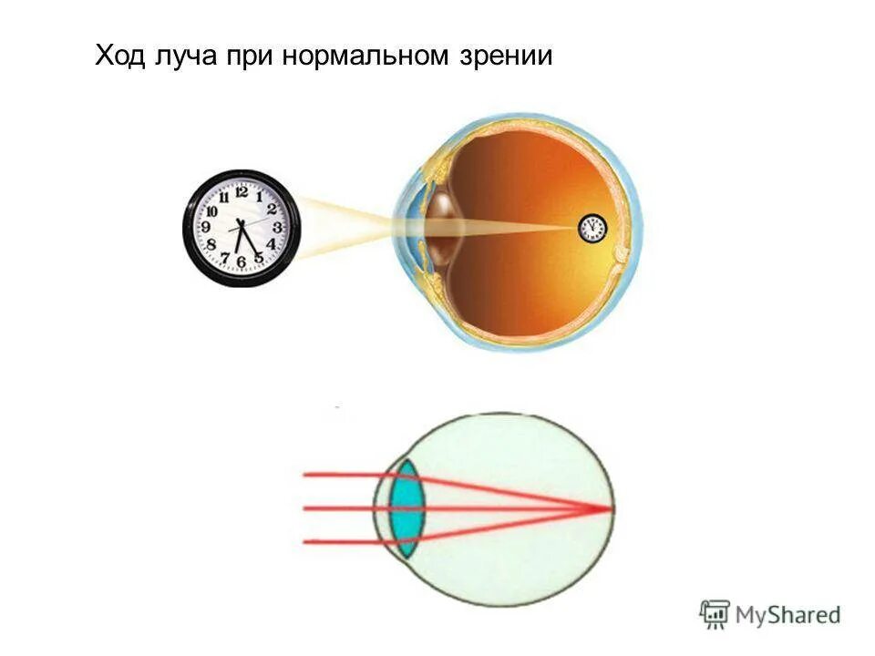 Миопия схема преломления лучей. Ход лучей близорукость и дальнозоркость. Близорукость ход лучей в глазе. Нормальное зрение схема. Нормальный глаз схема