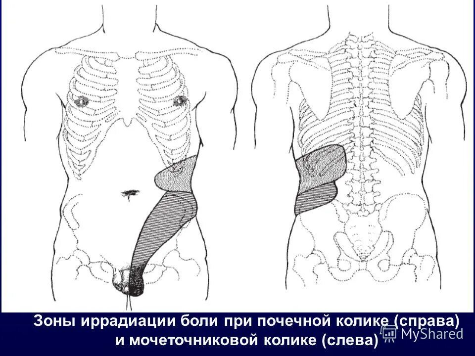 Болит поясница справа и отдает в живот. Иррадиация боли при почечной колике. Почечная колика иррадиация болей. Почечная колика болевая зона. Иррадипция боли при почечной Колик.