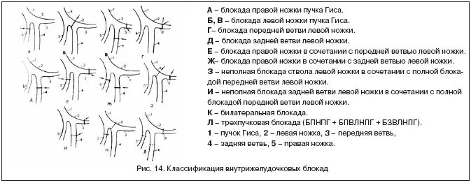 Неполная блокада ножек и ветвей пучка гиса