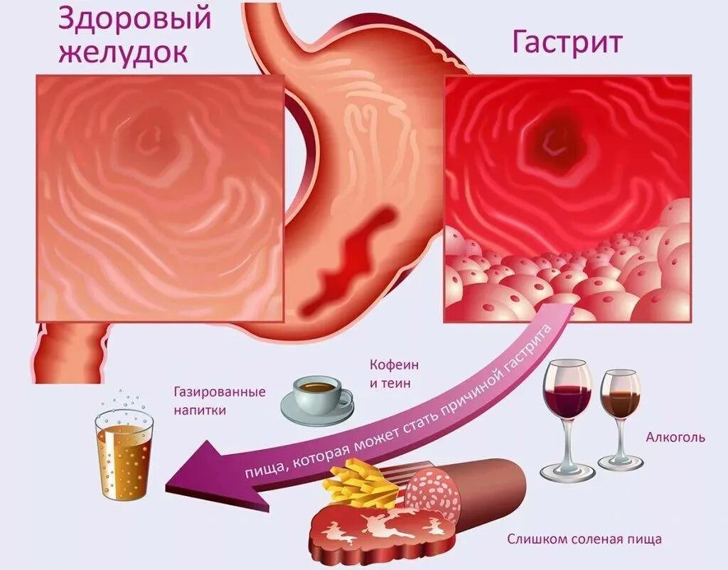 Сколько проходит гастрит