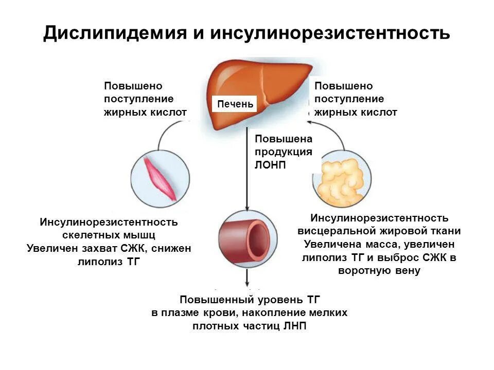 Препараты лечащие инсулинорезистентность. Инсулинорезистентность и дислипидемия. симптомы дислипидемии. дислипидемия клинические проявления. причины развития инсулинорезистентности.