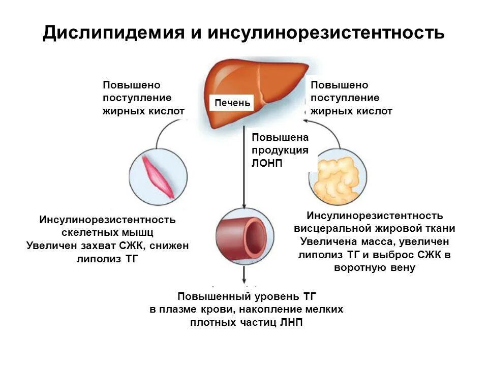 Инсулинорезистентность симптомы у мужчин. Атеросклероз механизмы развития дислипидемии. Инсулинорезистентность и дислипидемия. Синдром дислипидемия. Дислипидемия что это такое как лечить.