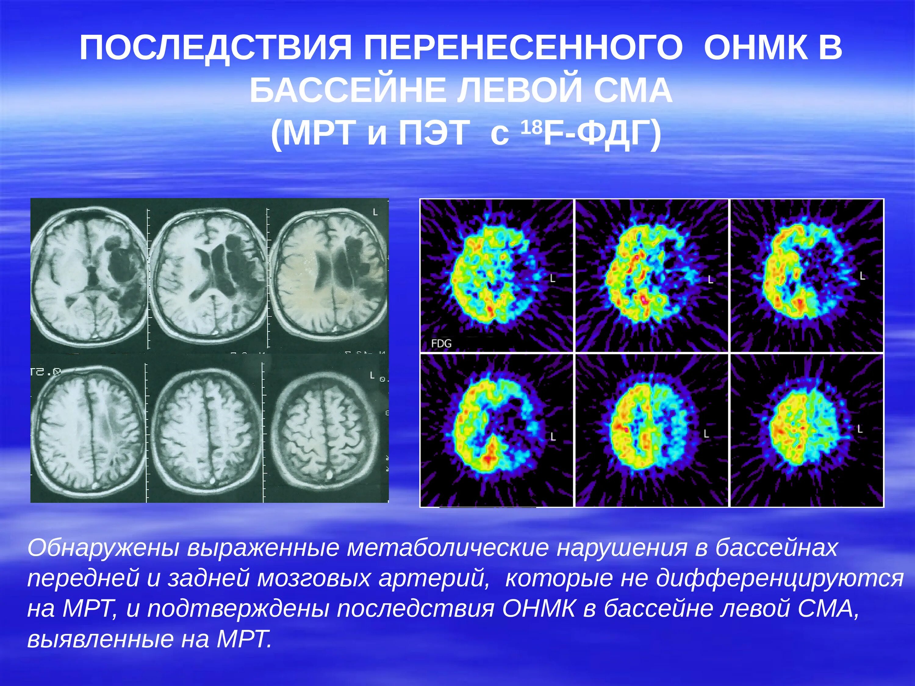 ОНМК В бассейне СМА. ОНМК В бассейне левой СМА. ОНМК средней мозговой артерии. ОНМК В бассейне средней мозговой артерии.