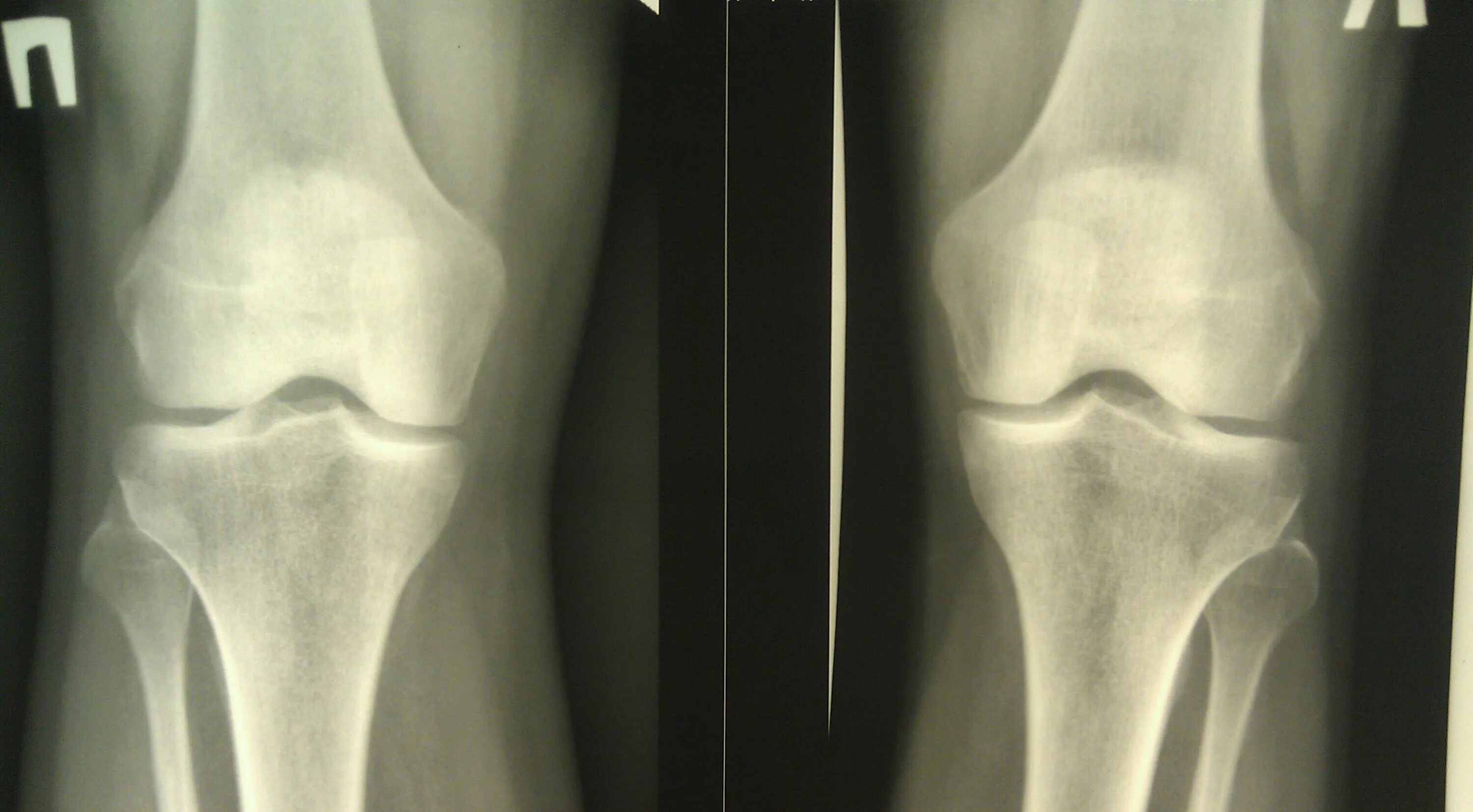Асептический некроз медиального мыщелка. Асептический некроз коленного кости. Асептический некроз надколенника. Асептический некроз коленного сустава рентген.